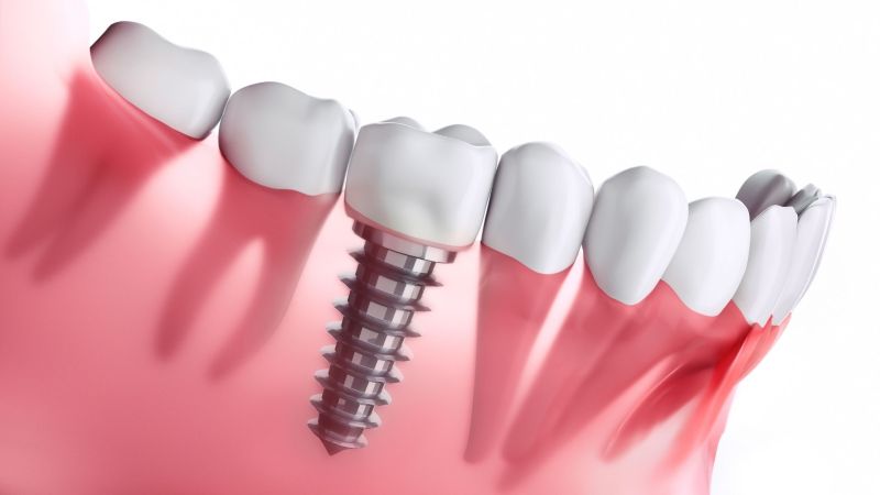 dental implants near you