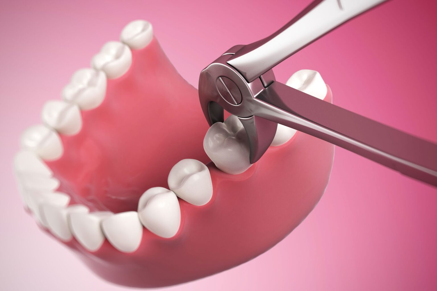 Wisdom Tooth Extractions Sherwood Park | Wisdom Tooth Extractions Near You