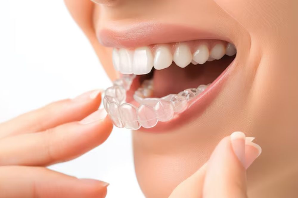 Invisalign in Sherwood Park