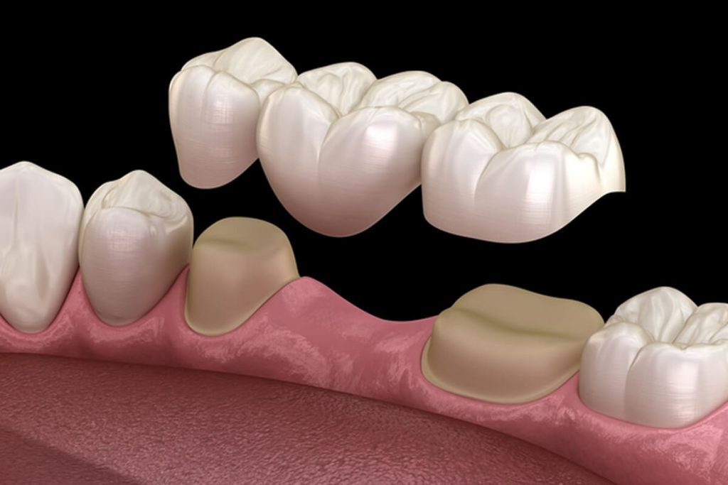 dental bridges in sherwood park