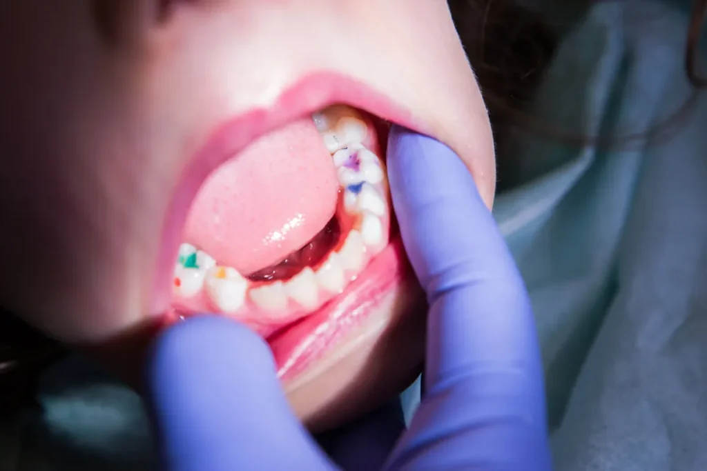 dental fillings for kids in sherwood park
