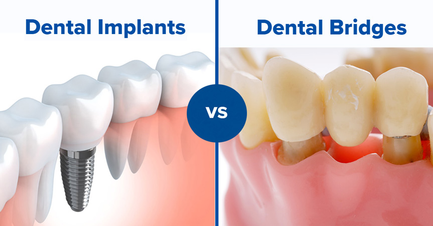 dental-implants-vs-bridges-in-sherwood-park-which-option-lasts-longer
