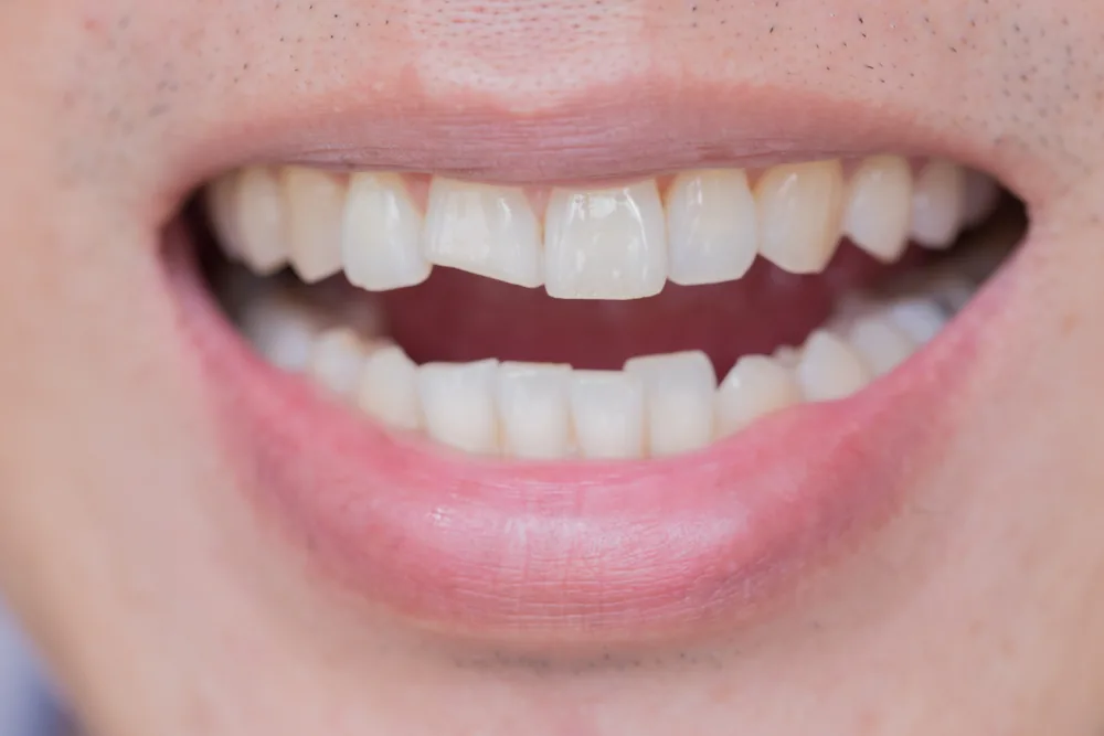 Close-up of a person's open smile showing the upper and lower front teeth